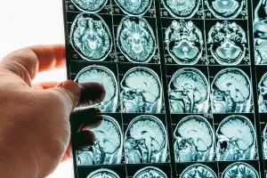 Doctor hand holds MRI brain scan or magnetic resonance image results.