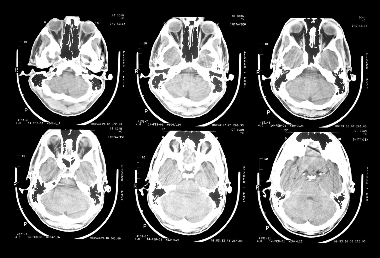 Звуки мрт мозга. Canadian CT head Rule.